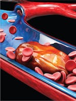 Tromboza venoasă - Cauze, simptome, tratament