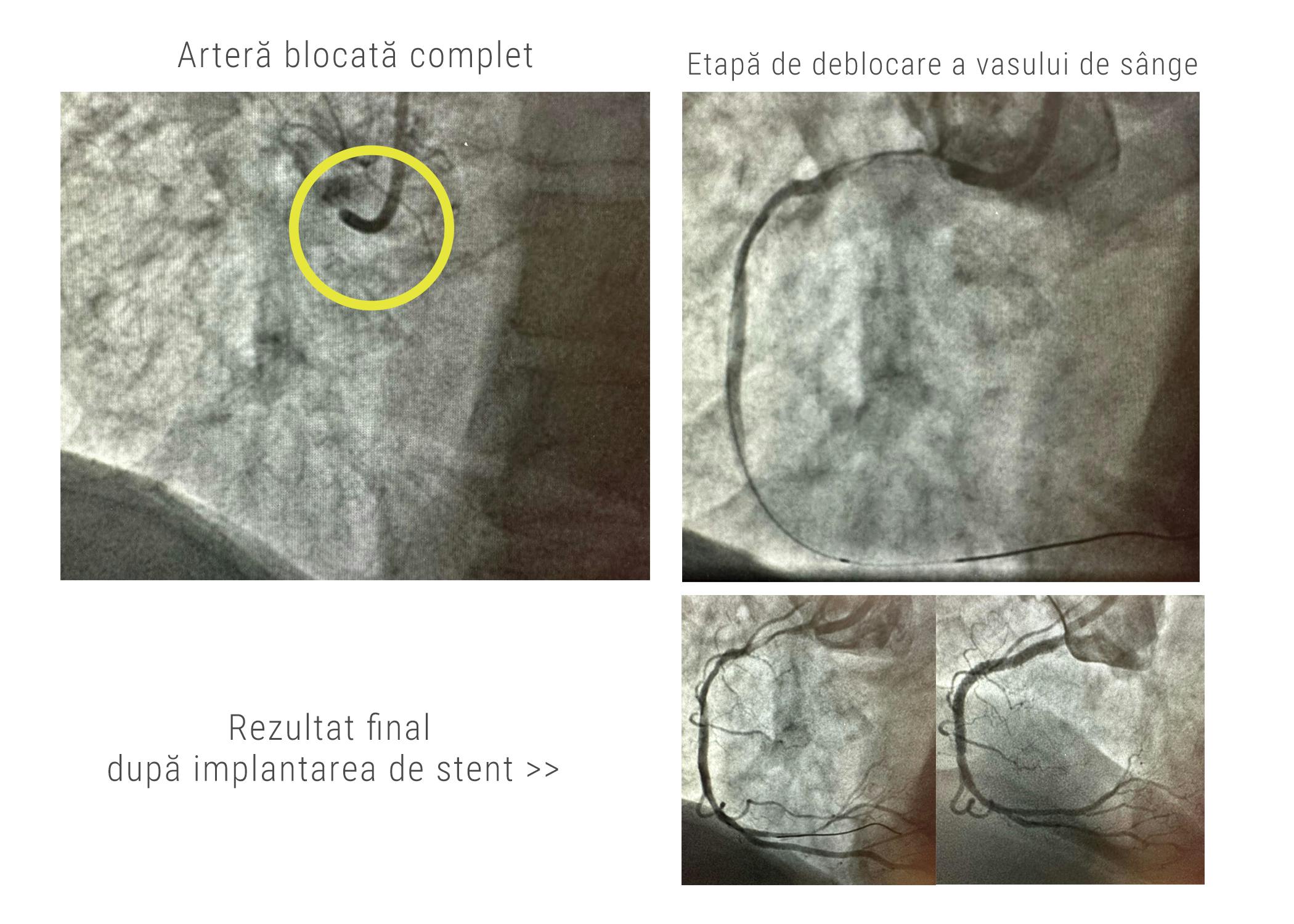 Imagini angiografice inainte si dupa tratamentul interventional