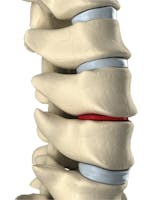 Hernia de disc - cauze, simptome, tratament
