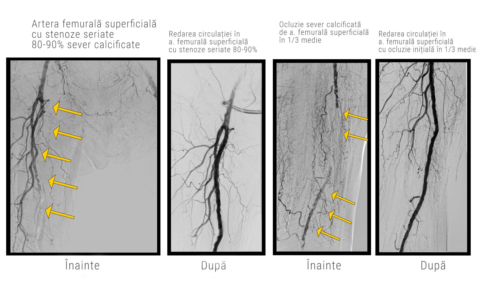 Imagine angiografica a arterei femurale superificiale calcificate, înainte și dupa interventia de Jetstream