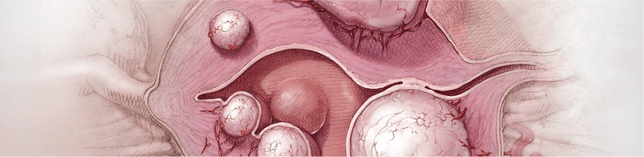 Embolizare fibrom uterin - Tratament minim invaziv | ARES