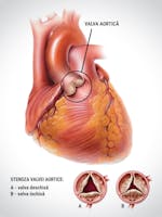 Stenoza aortică – cauze, simptome, tratament