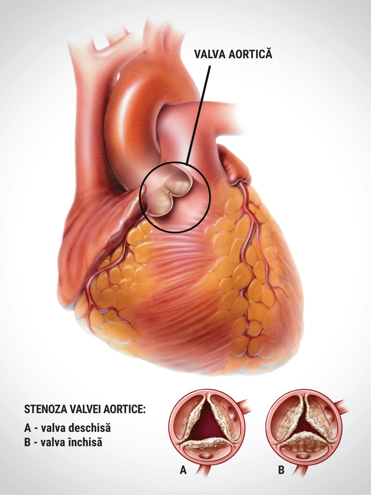 Stenoza aortică – cauze, simptome, tratament