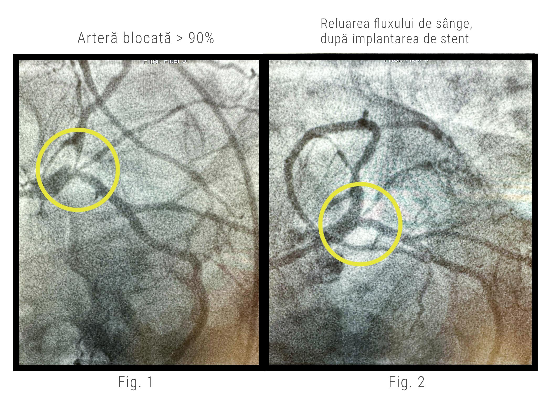 Leziuni coronariene vizualizate angiografic inainte si dupa implantarea de stent