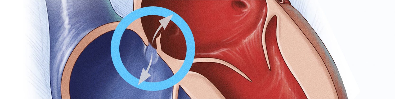 Corectia Foramen Ovale Patent (PFO) | MONZA ARES