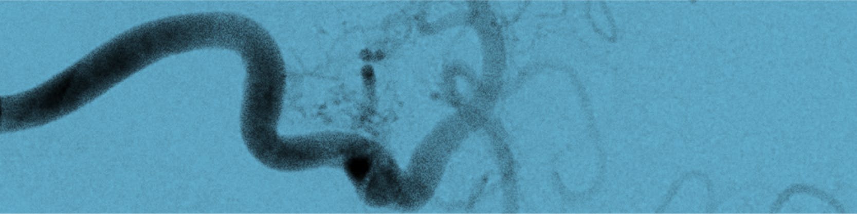 Fistula arterio-venoasa pulmonara | MONZA ARES | Inovatie in Cardiologie