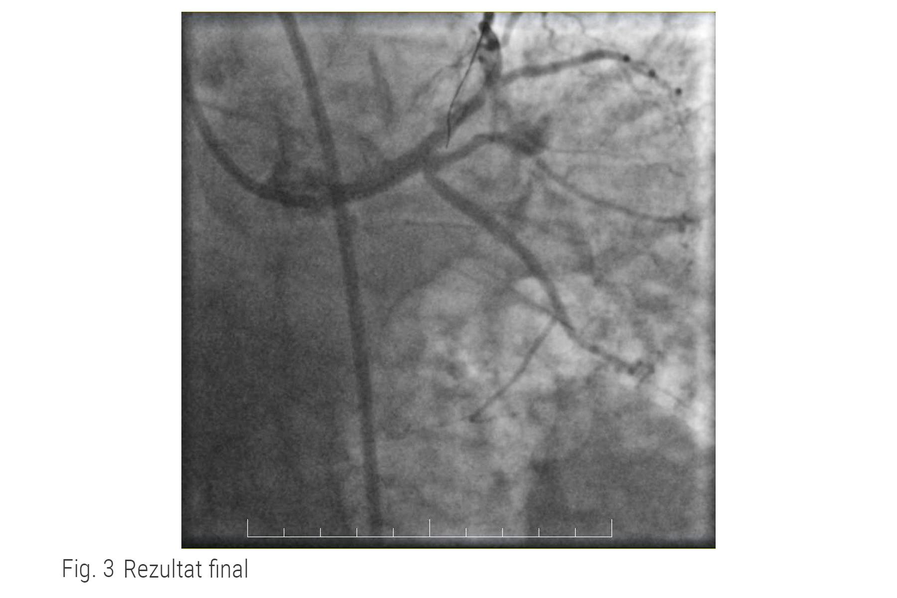 Rezultat angiografic după implantarea de stent pentru tratamentului unei subocluzii de trunchi comun