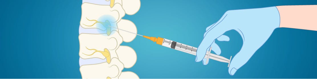 Infiltrații transforaminale | Infiltratii coloana | MONZA ARES