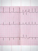 Fibrilație atrială – cauze, simptome, tratament