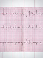 Fibrilație atrială – cauze, simptome, tratament