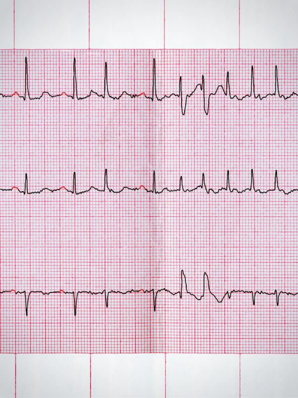 Fibrilație atrială – cauze, simptome, tratament