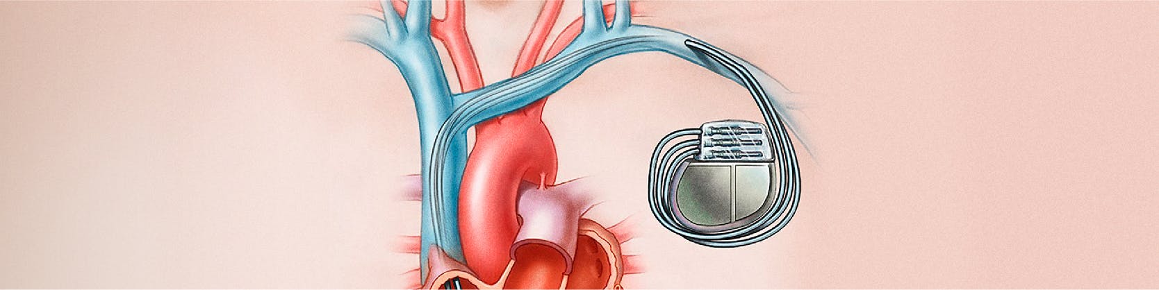 Implantare stimulator cardiac - pacemaker | MONZA ARES