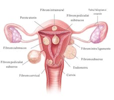 Fibrom uterin? Cat de mare poate creste un fibrom?