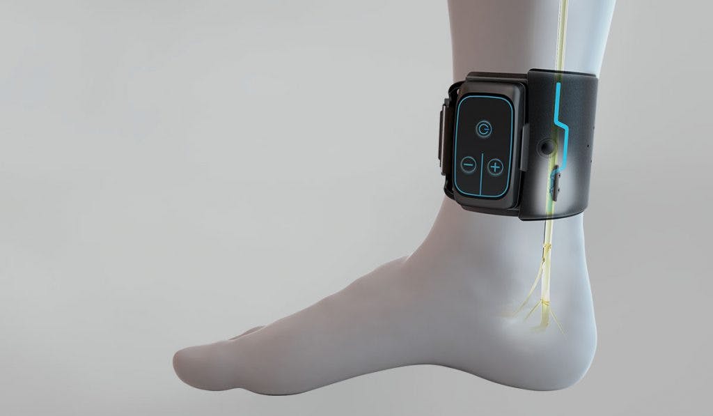 Image: BlueWind Medical