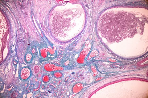 In The Lab: Ovarian Cancer Cells Show Mutation From Talc Exposure