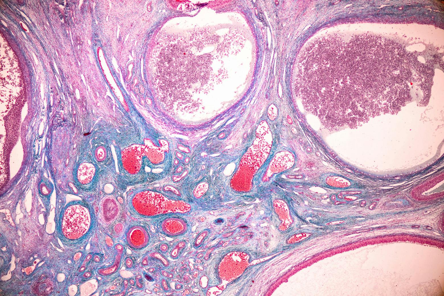 In The Lab Ovarian Cancer Cells Show Mutation From Talc Exposure 