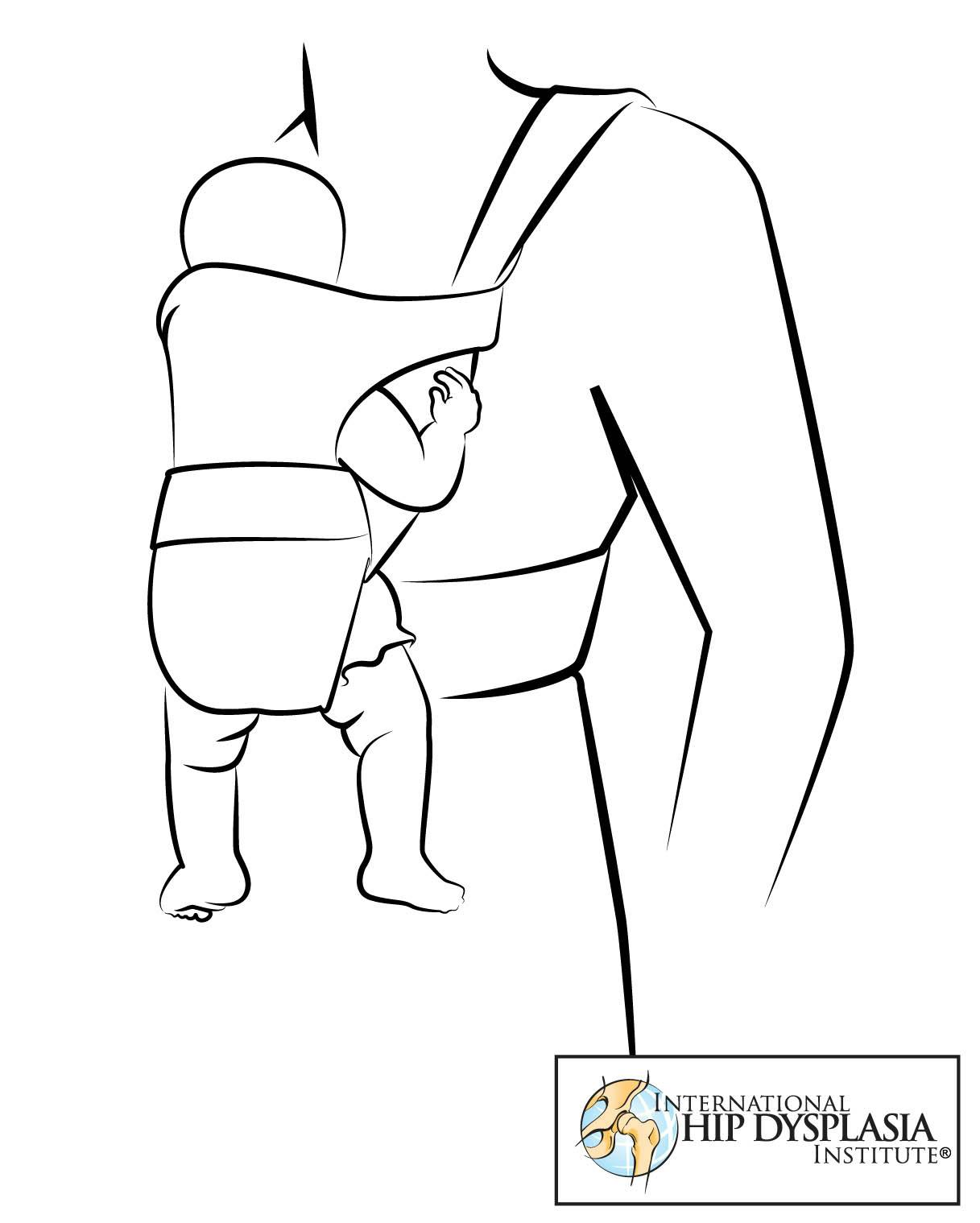 Hip dysplasia outlet baby carrier