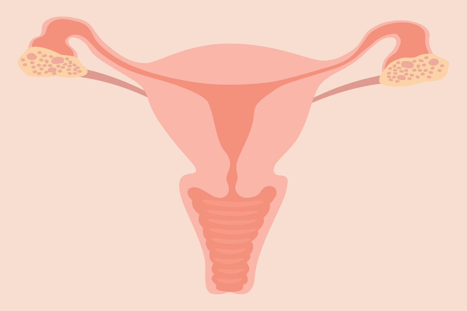 Pink illustration of the female reproductive system as it depicts the way ovarian cancer in fallopian tubes may be the starting point.
