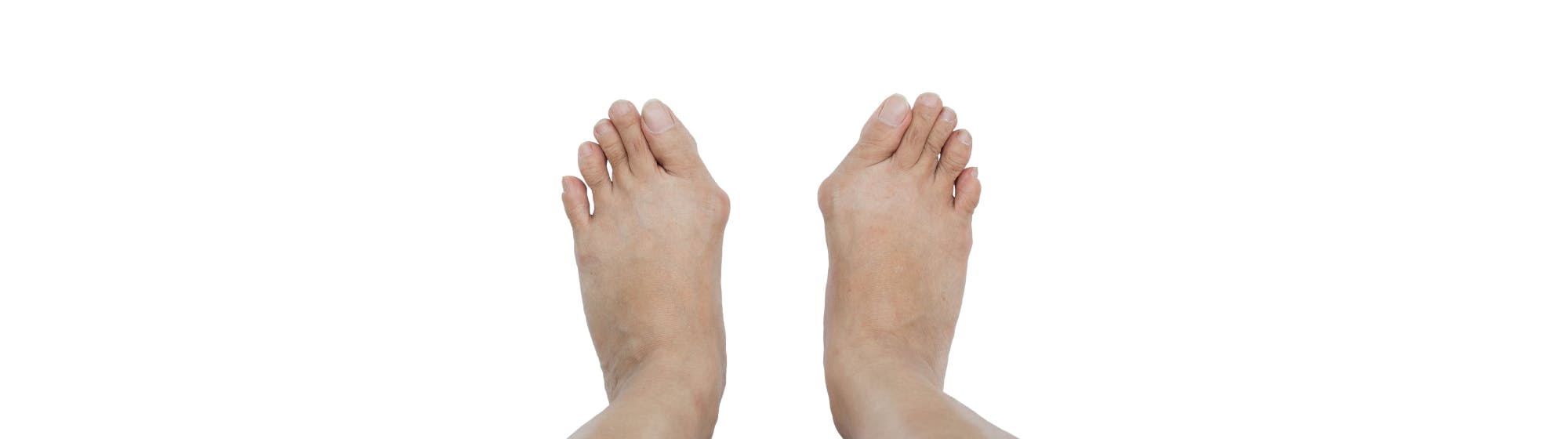 zwei Füße mit Hallux Valgus