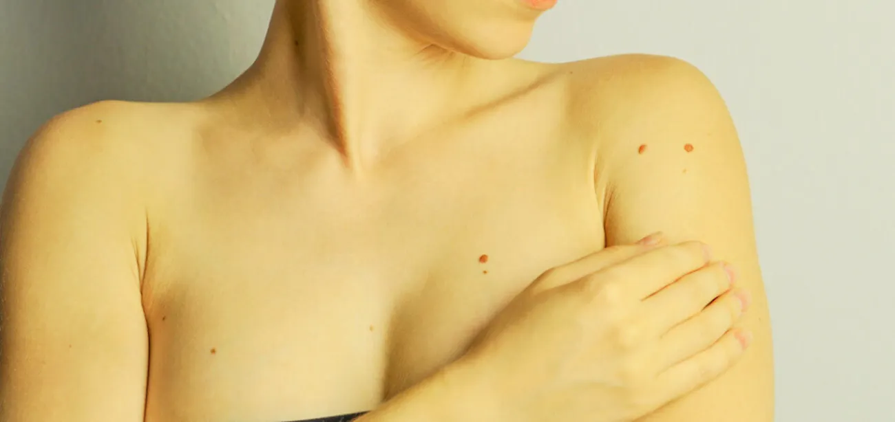 a lady experiencing jaundice in adults
