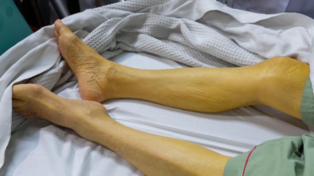 Patient experiencing Liver-related Causes of Jaundice