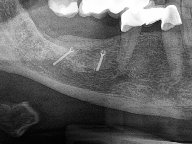 Knochenaufbau Augsburg