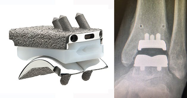 Ankle Replacement