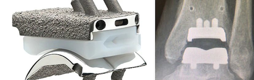 Ankle Replacement