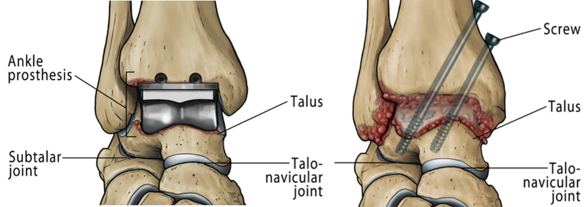 Ankle Replacement Vs Ankle Fusion
