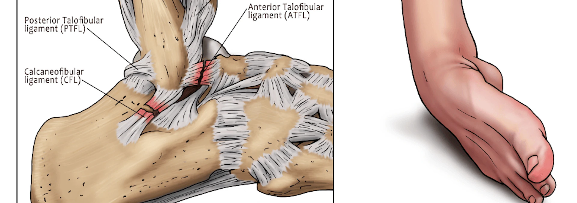 sprained ankle illustration by myankle