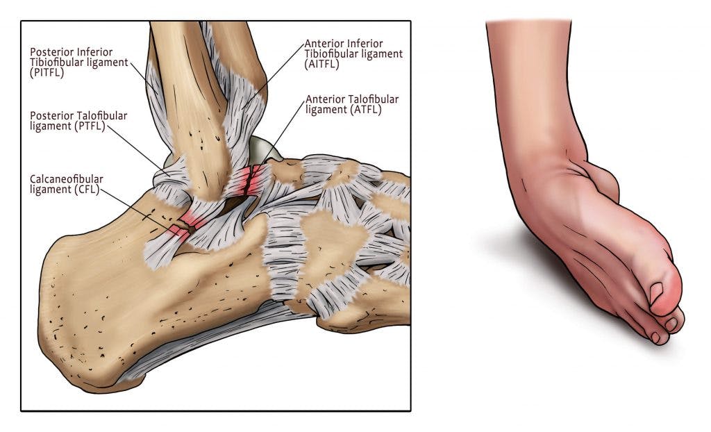 sprained ankle and painful ankle