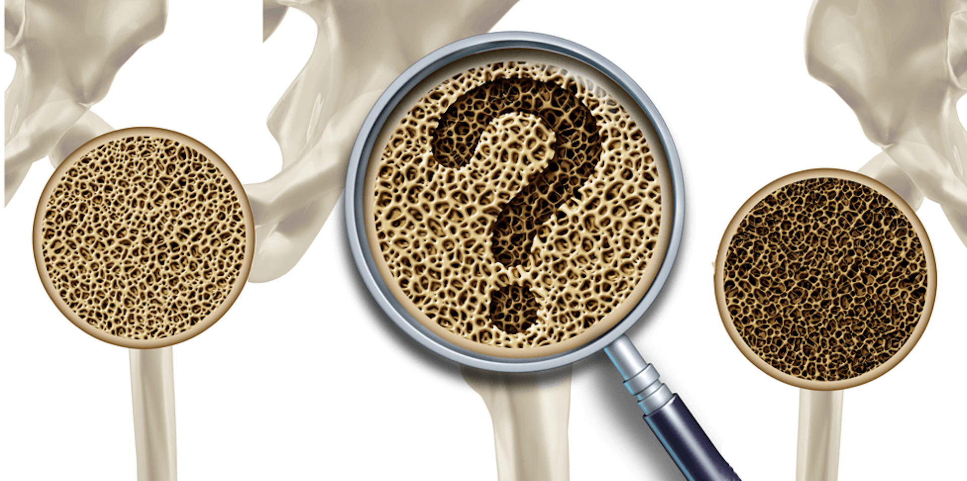 difference-osteoporosis-osteoarthritis