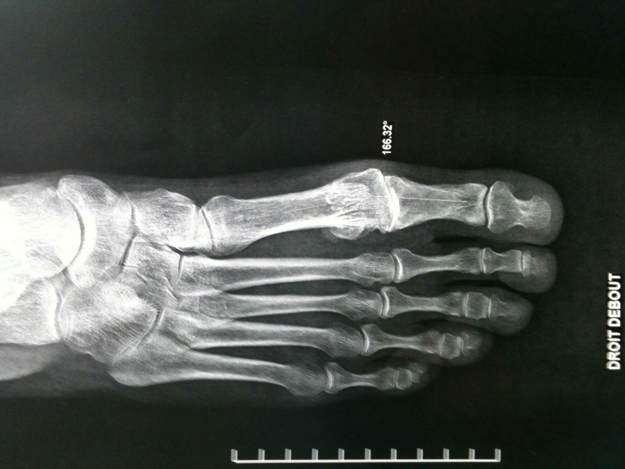 Hallux Rigidus Painful Big Toe arthritis