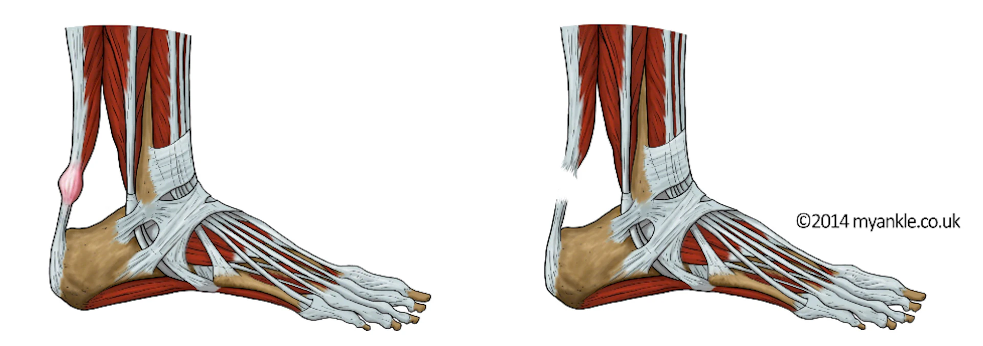 Achilles Tendinopathy achilles tendon pain myankle
