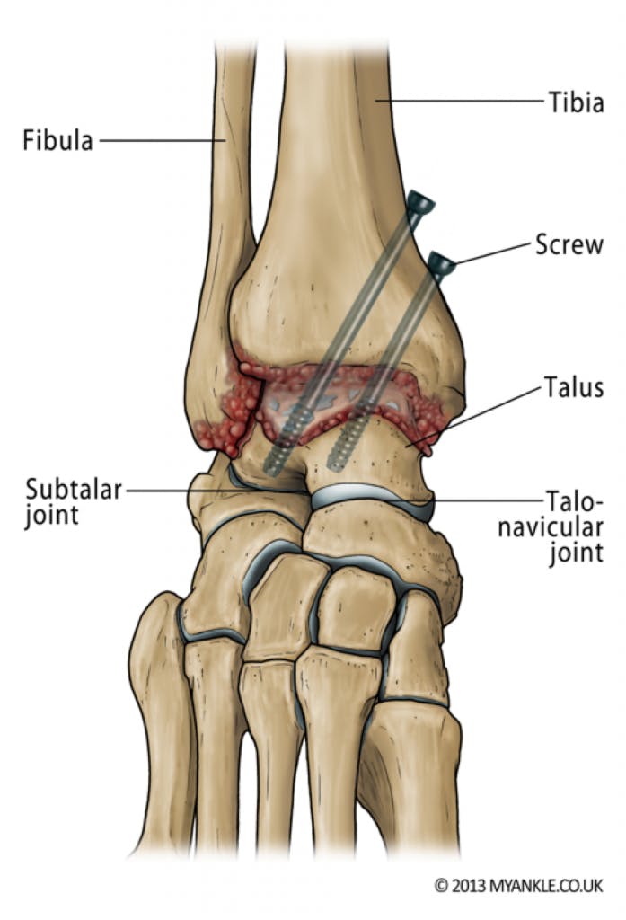 ankle fusion surgery arthrodesis london