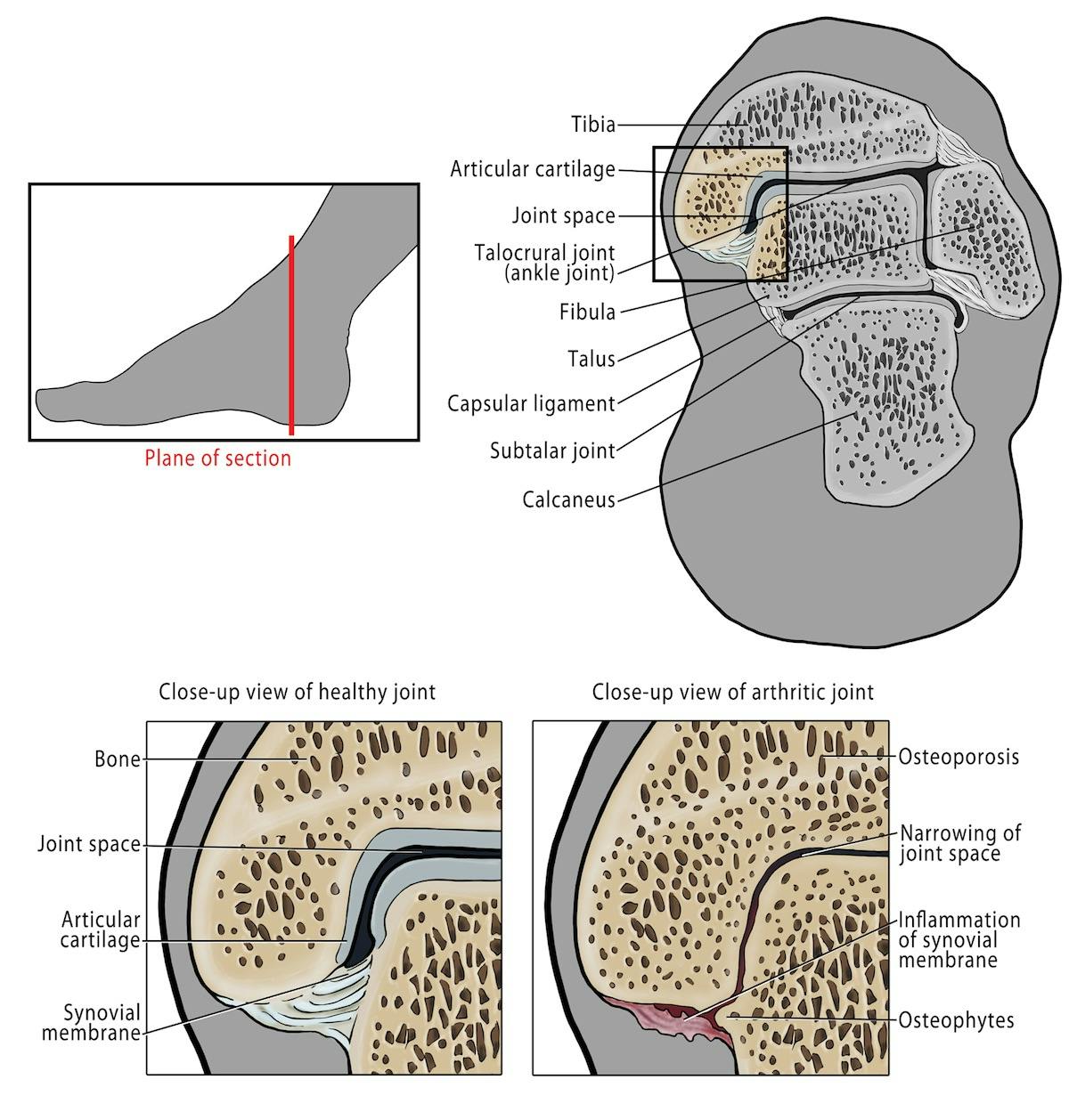 healthy joint and arthritic ankle joint ankle arthritis osteoarthritis