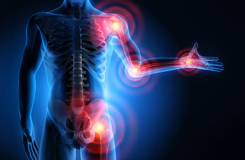 Digital image of arthritis