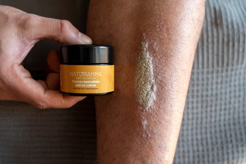 CBD para aliviar los síntomas de la psoriasis