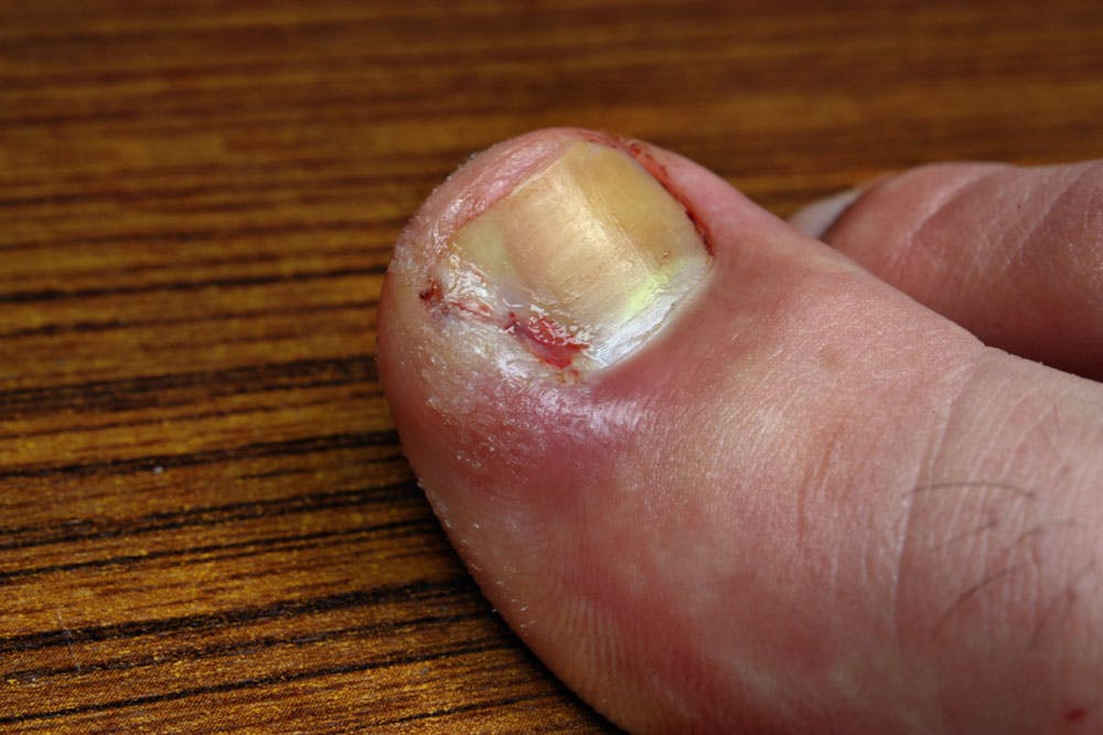 Is My Ingrown Toenail Infected?: Town Center Foot & Ankle: Podiatry