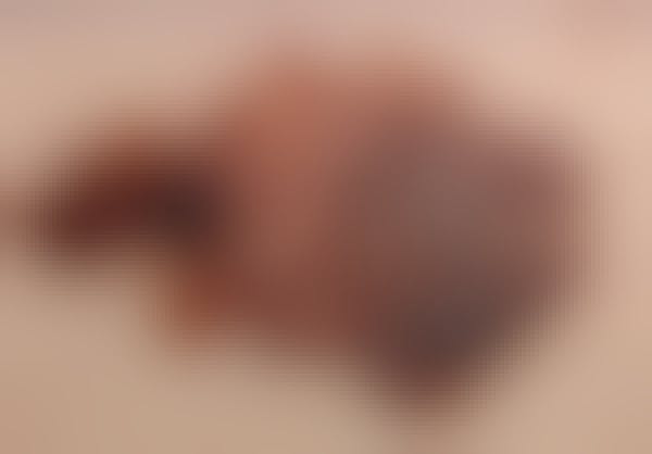 Close-up photo of a melanoma