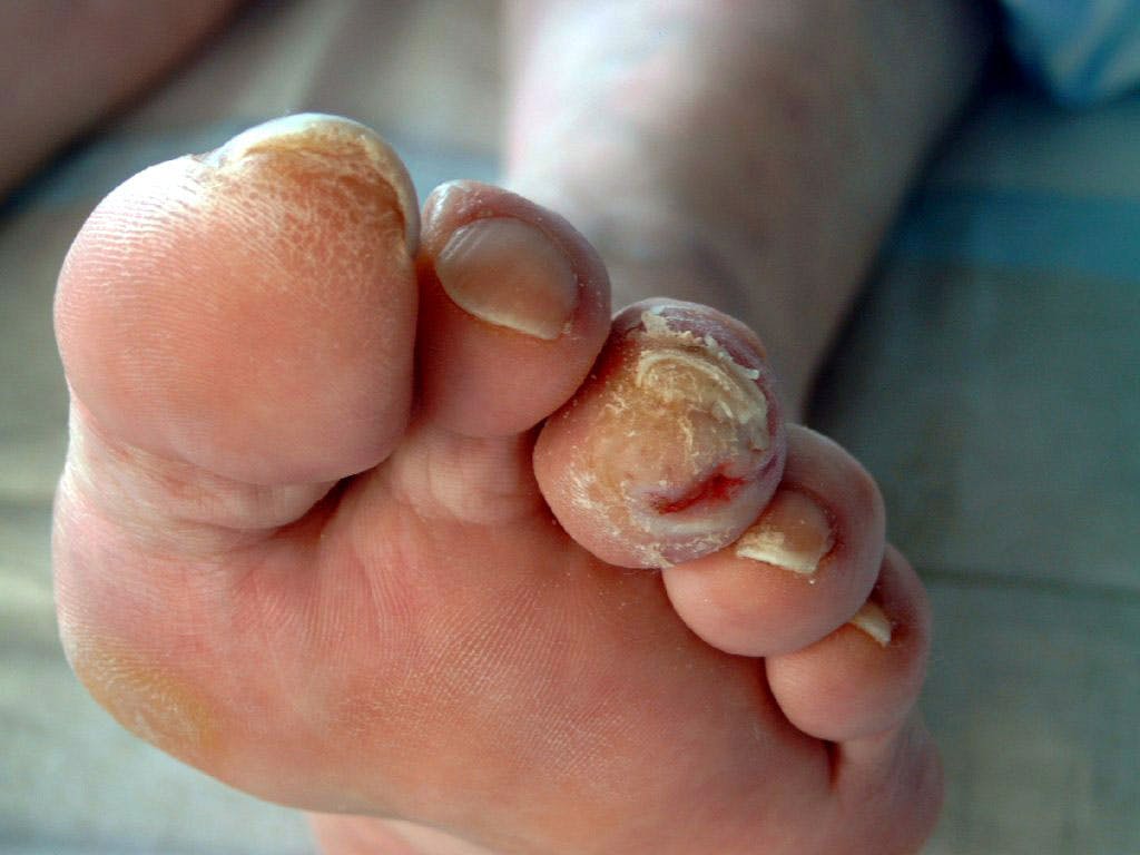 Diabetic foot photo