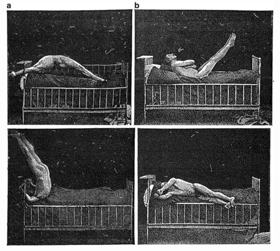 1887 photograph by the French neurologist and alienist Jean-Marie Charcot, depicting a "hysterical attack in a male patient." A nude man is twisting in various ways on a bed.