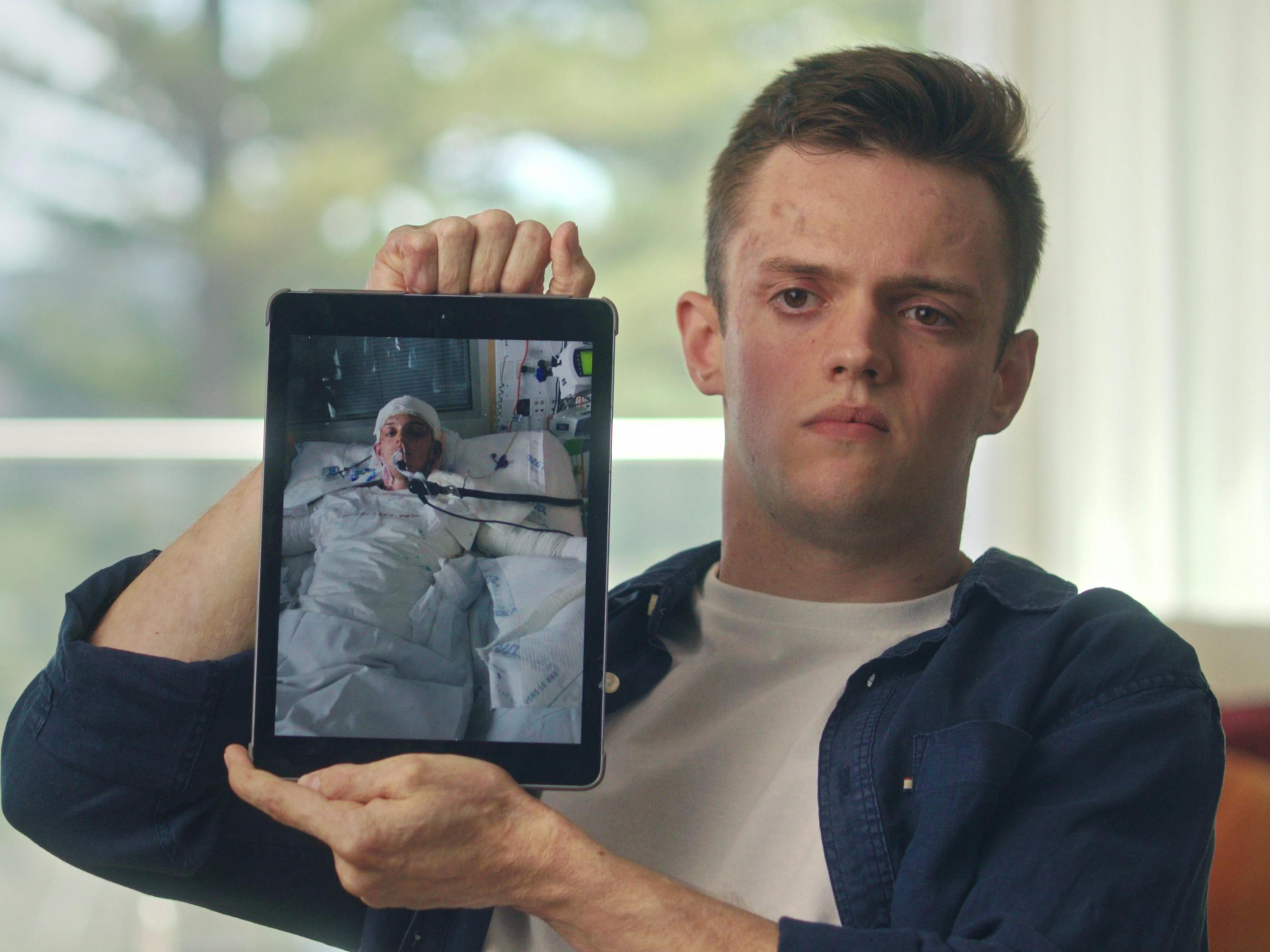 Jesse Langford holds up a picture of himself after the volcano, swaddled in bandages in a hospital bed hooked up to a bunch of machines.