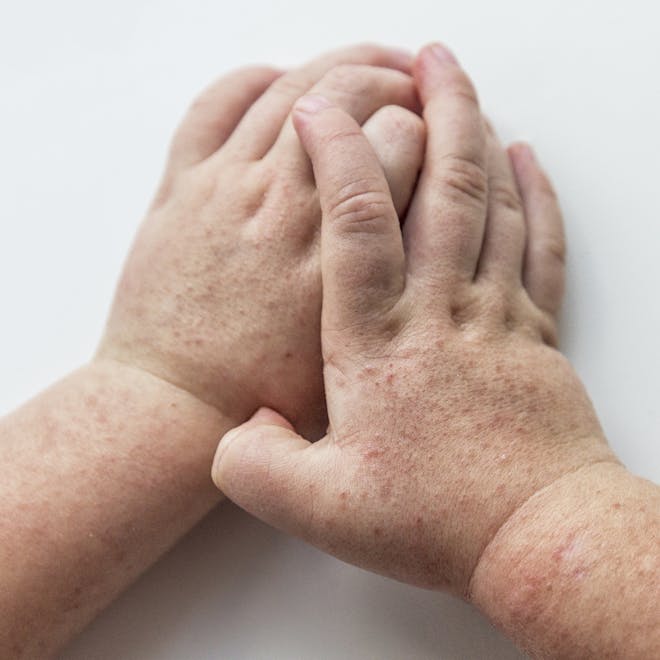 Child's hands with scarlet fever rash