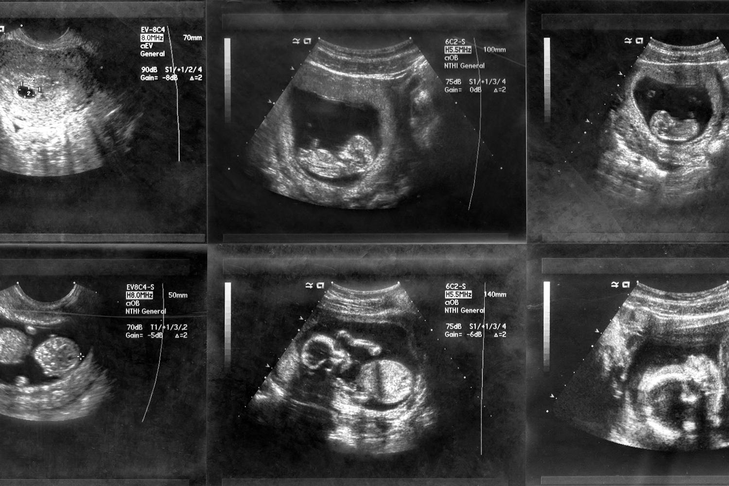 Weeks ultrasound at 4 5