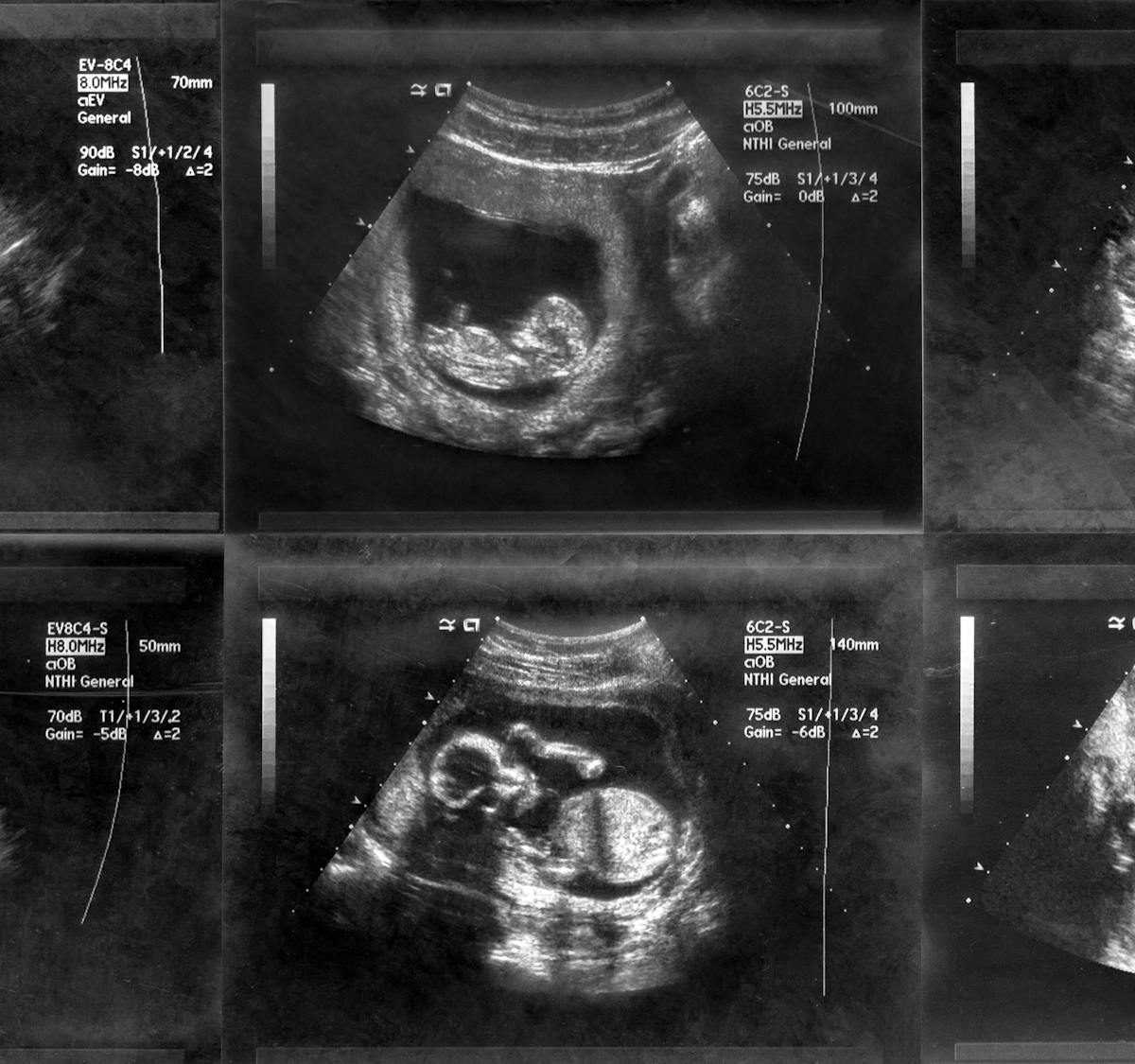 Week By Week Pregnancy Scan Photos Netmums Week By Week Pregnancy Scan Photos Netmums