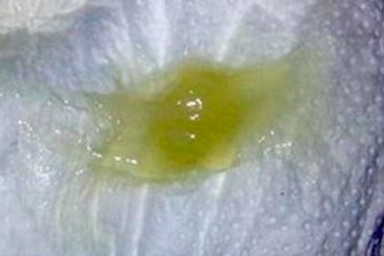 Green-tinged vaginal discharge