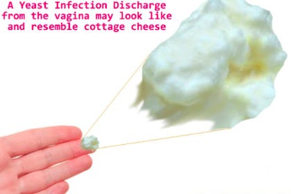 thrush yeast infection discharge