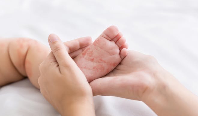 close up of baby's feet with measles
