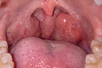 Tonsils inside mouth